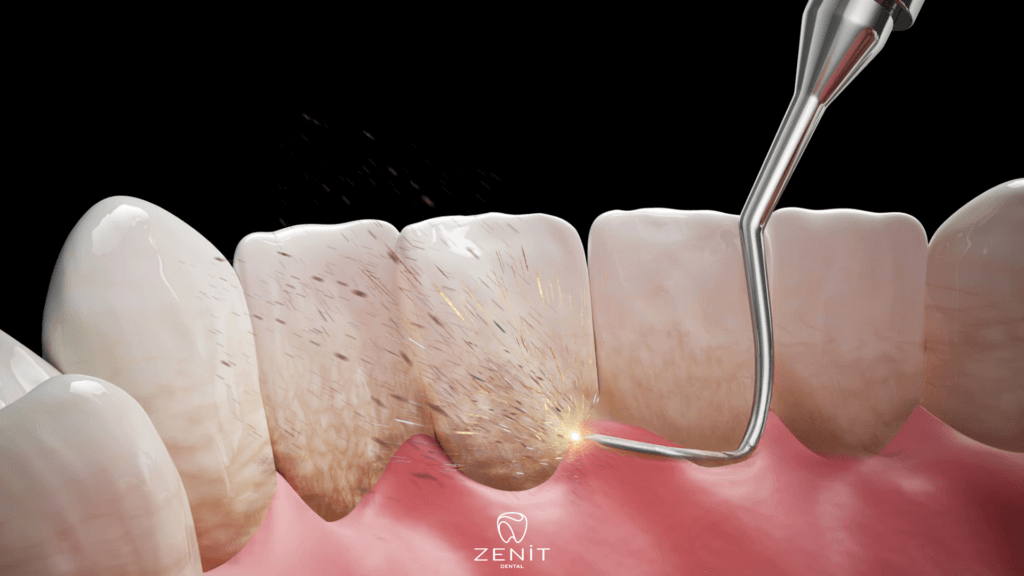 Is Dental Stone Cleaning Harmful