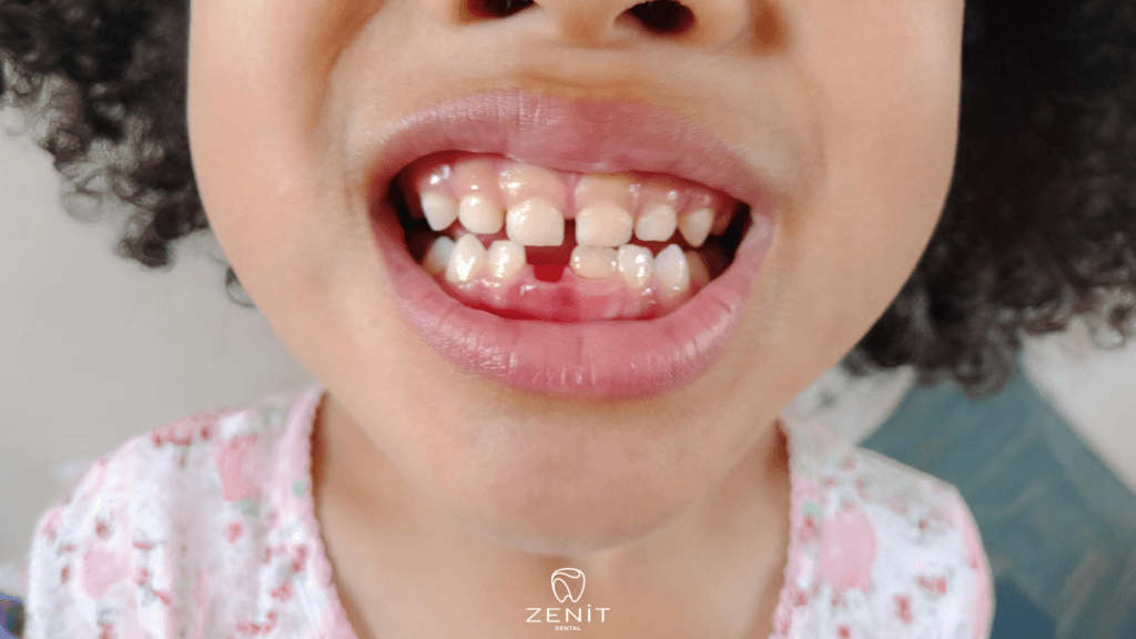 When do milk teeth fall out?