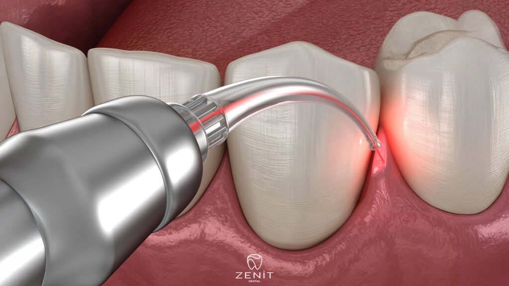 Laser Procedures 