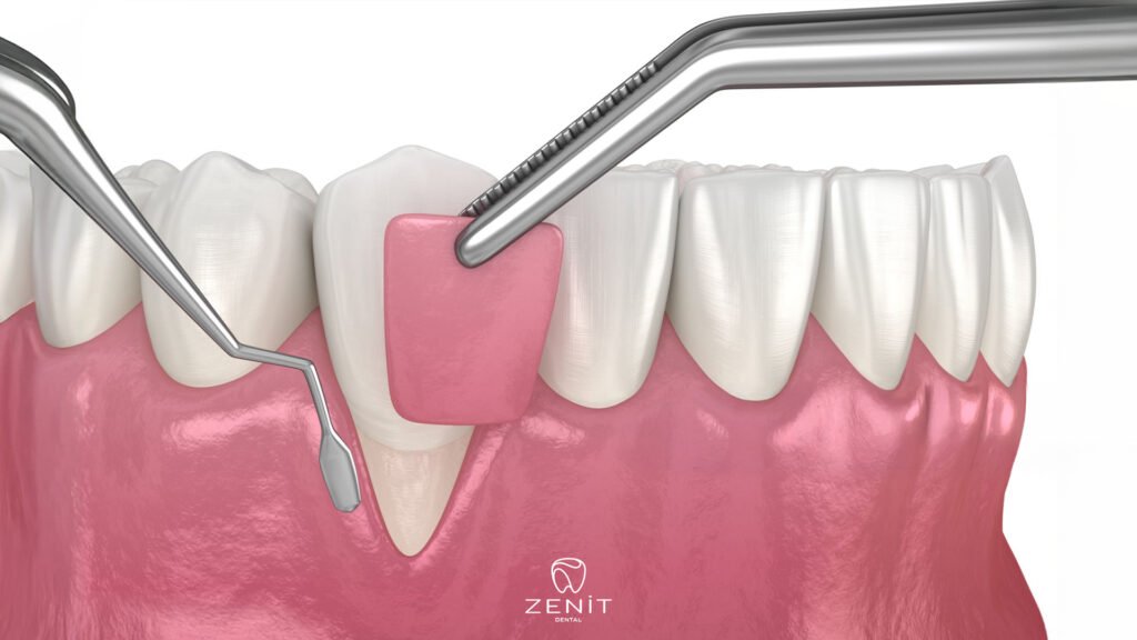 Gum Graft