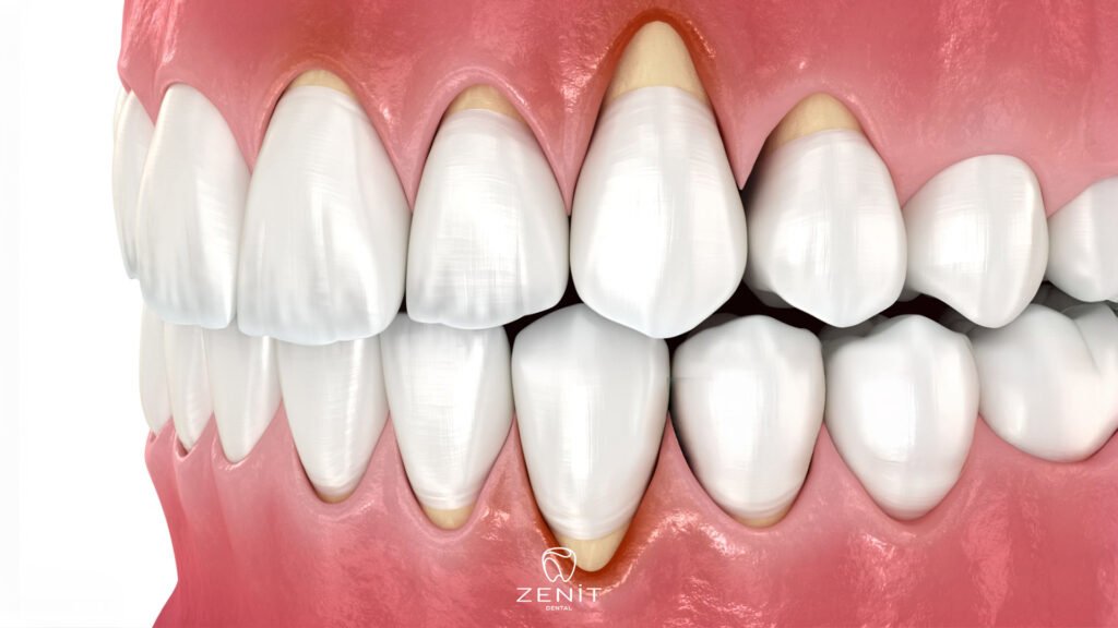 Gum Graft