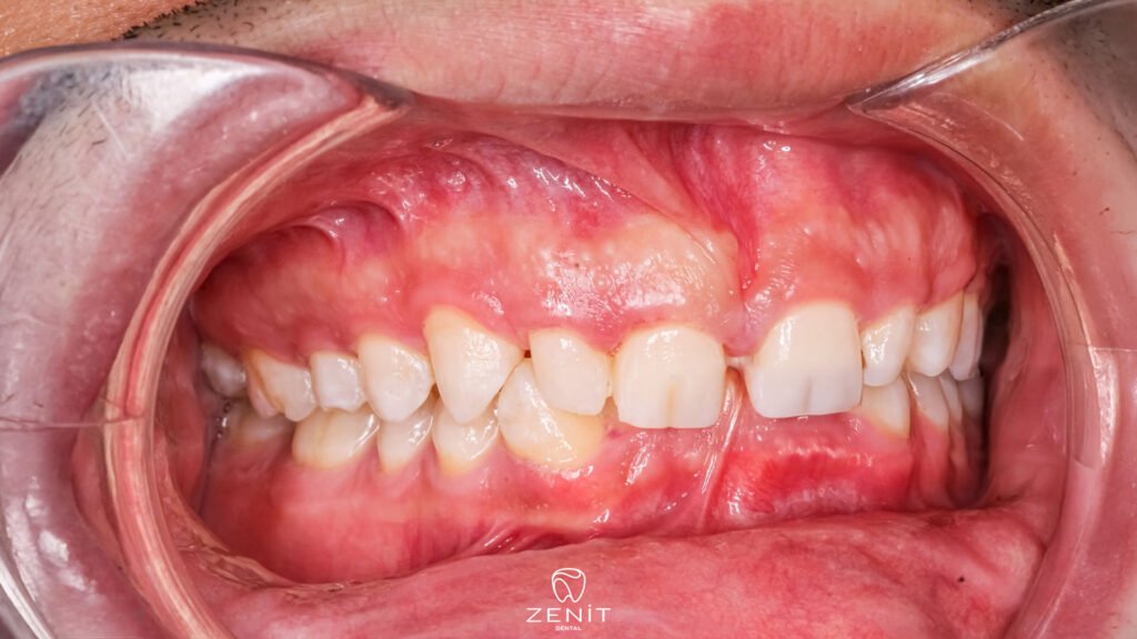 Gum Graft