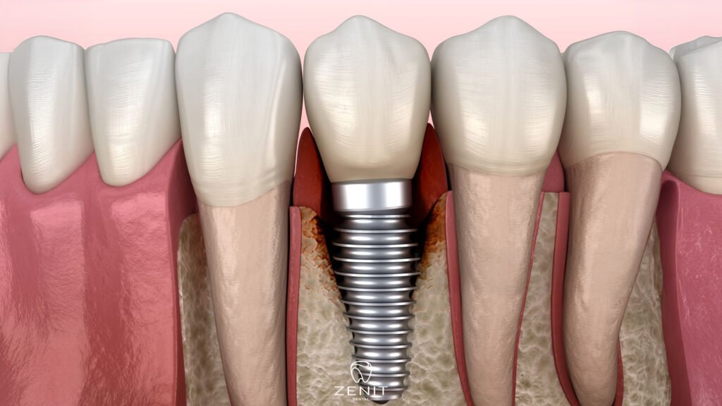 What is Periimplantitis