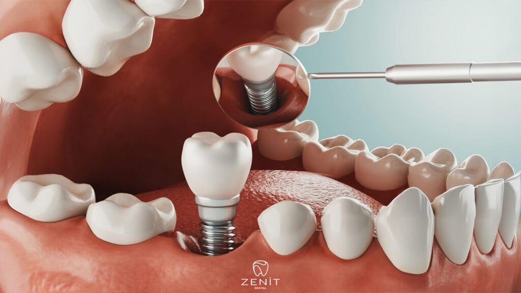 Can Diabetics Get Implants