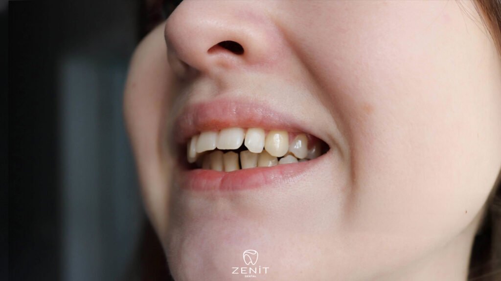 overbite nedir