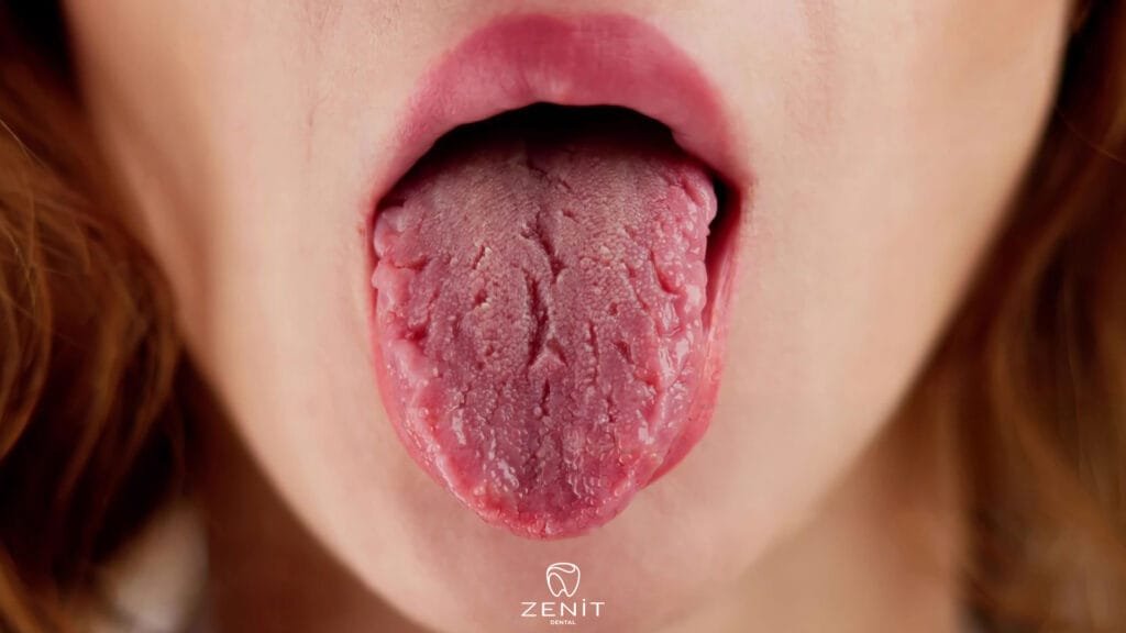 Ağız Kuruluğu Nedenleri? Nasıl Geçer?