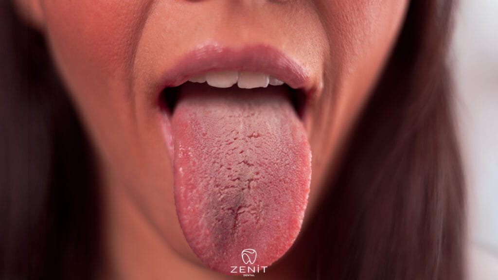 What Causes Dry Mouth
