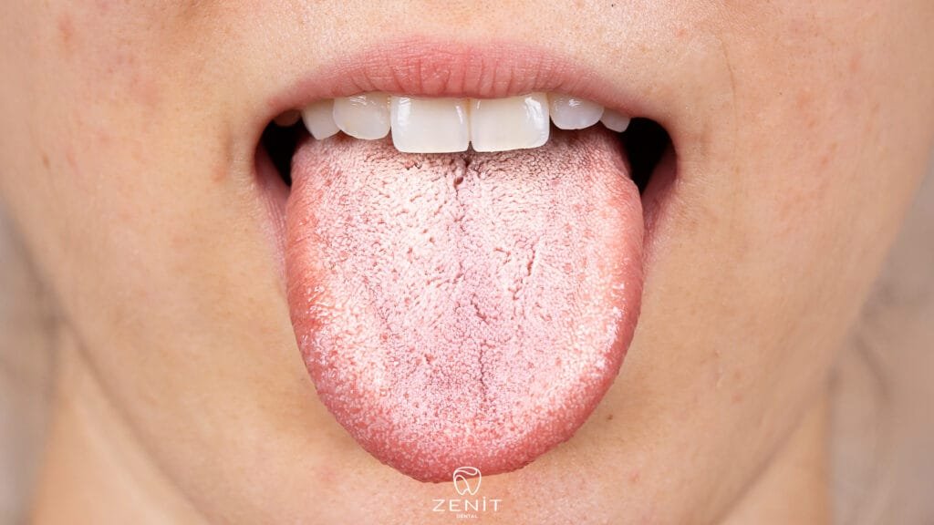 What Causes Dry Mouth