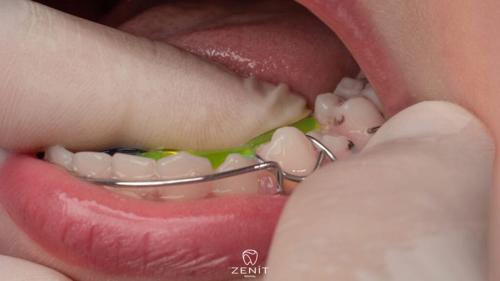 What is a Placeholder