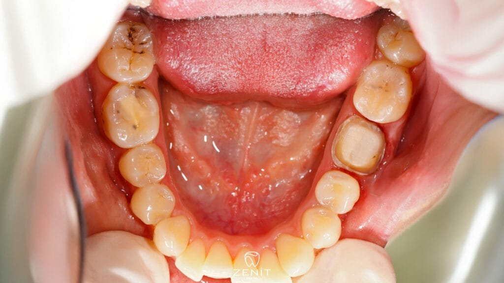 Why Do Our Teeth Decay