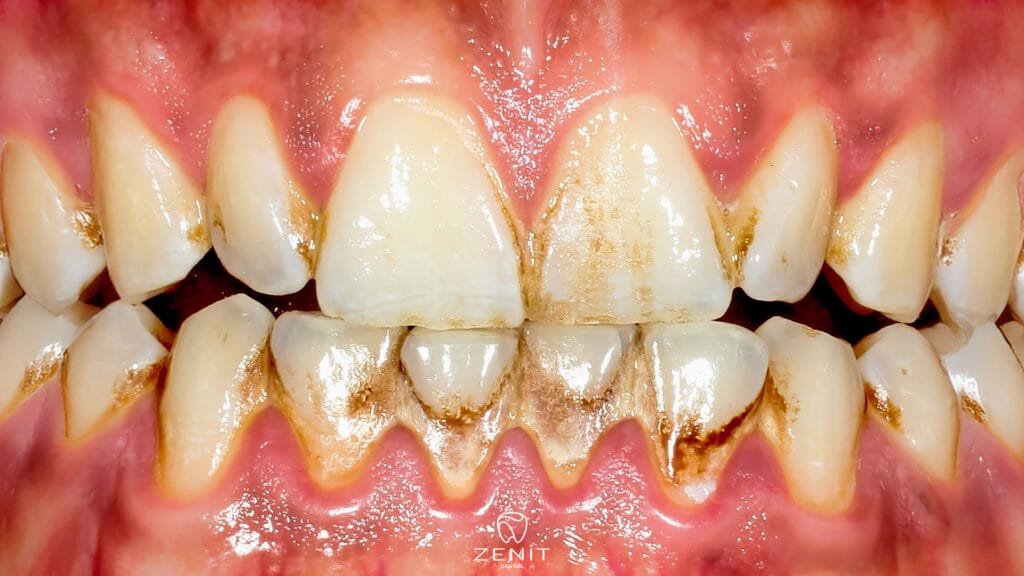 Why Do Our Teeth Decay