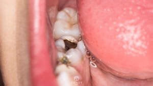 Dişlerimiz Neden Çürür