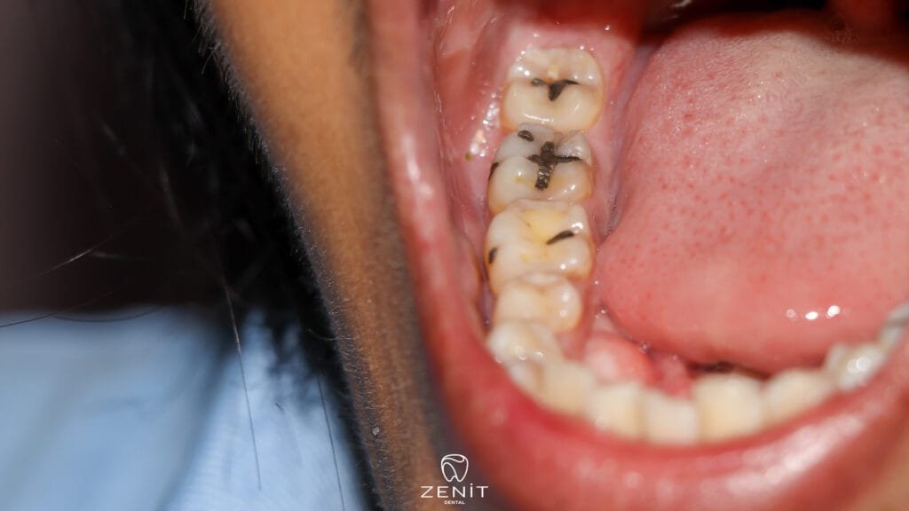 Why Do Our Teeth Decay