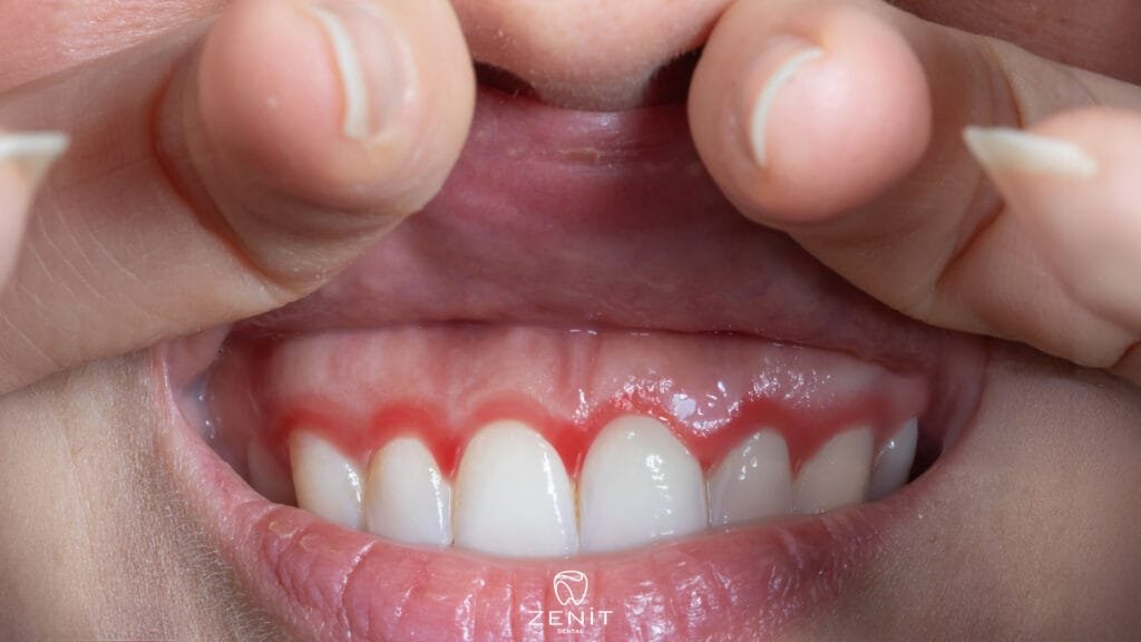 Hamilelik Gingivitisi Nedir